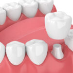 A dental crown capping a natural tooth that was damaged in Canton, GA